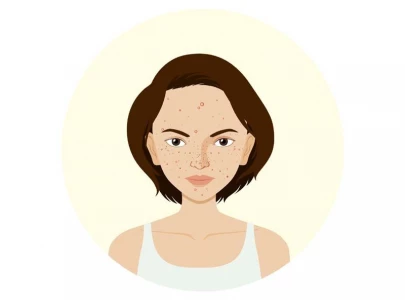 skincare 101 simple ways to treat your pimples