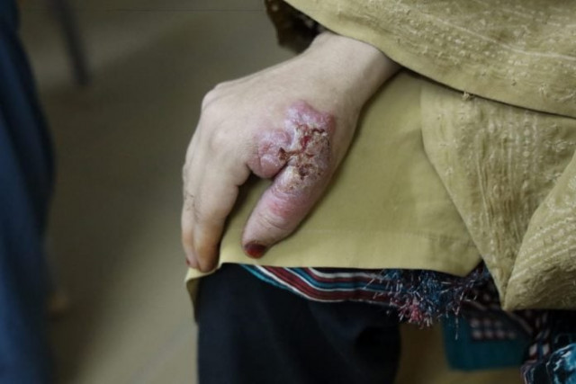 experts fear surge in infectious diseases amid afghan refugee influx experts fear surge in infectious diseases amid afghan refugee influx