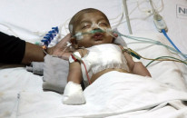 congenital heart defects on the rise in pakistan