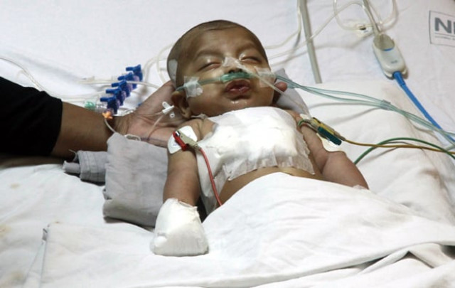 according to prof bangash around 3 000 surgeries are performed on children born with congenital heart diseases in pakistan photo athar khan express according to prof bangash around 3 000 surgeries are performed on children born with congenital heart diseases in pakistan photo athar khan express
