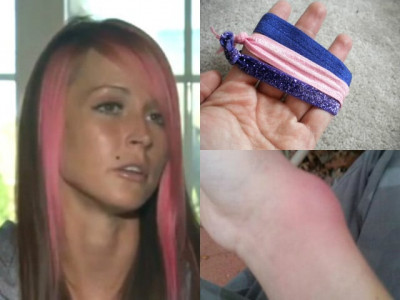 hair tie causes infection on woman s wrist hair tie causes infection on woman s wrist