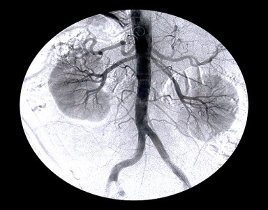 sri lanka launches investigation into alleged human kidney racket