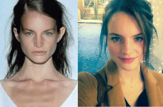 ex top model battles anorexia    holds fashion world accountable