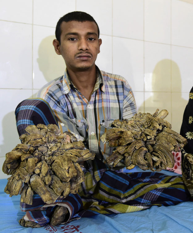 abul bajandar l 26 dubbed quot tree man quot for massive bark like warts on his hands and feet sits at dhaka medical college hospital in dhaka on january 31 2016 photo afp