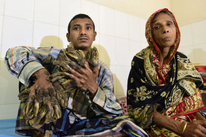 bangladesh s tree man undergoes successful surgery
