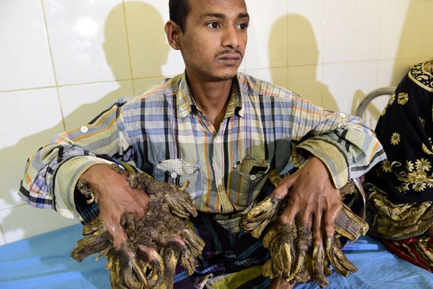 in this photograph taken on january 31 2016 bangladesh patient abul bajandar 26 dubbed quot tree man quot for massive bark like warts on his hands and feet sits at dhaka medical college hospital in dhaka photo afp