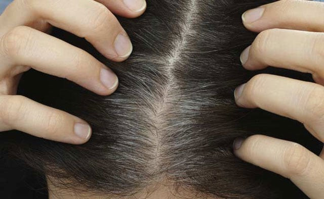 greying has a genetic component and is not just environmental photo ndtv greying has a genetic component and is not just environmental photo ndtv
