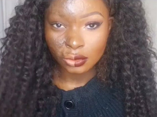 nchom was burnt in an oil frying incident when she was 9 years old photo buzzfeed nchom was burnt in an oil frying incident when she was 9 years old photo buzzfeed