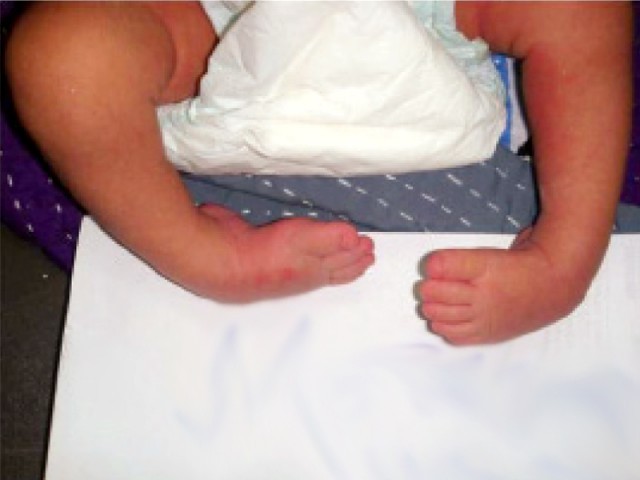 a baby boy with the club foot condition photo courtesy professor anisuddin bhatti of the jpmc