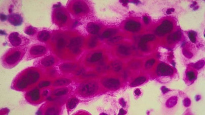 uganda s only cancer treatment machine breaks patients left waiting