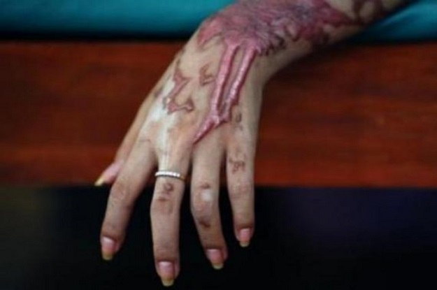 doctors say she has suffered burns on 25 per cent of her body photo reuters