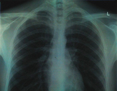 you have lung cancer uk patients told in christmas error