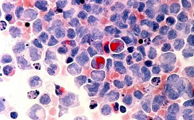 photomicrograph of human white blood cells with acute myelocytic leukaemia shown with an esterase stain photo reuters photomicrograph of human white blood cells with acute myelocytic leukaemia shown with an esterase stain photo reuters