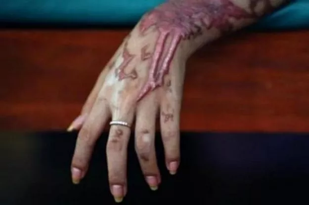 doctors at nishtar hospital told newsmen that iqra had suffered 70 per cent burns photo reuters doctors at nishtar hospital told newsmen that iqra had suffered 70 per cent burns photo reuters
