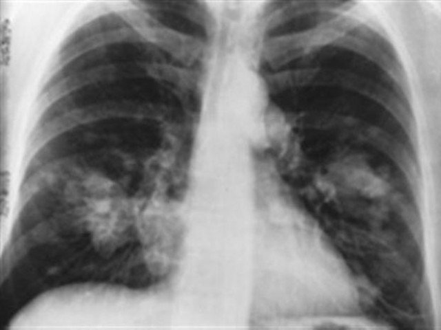 a file photo showing an x ray photo reuters