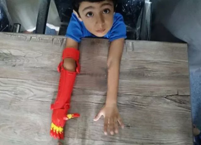 mir bayyaan baloch was born with a partially developed arm photo bioniks mir bayyaan baloch was born with a partially developed arm photo bioniks