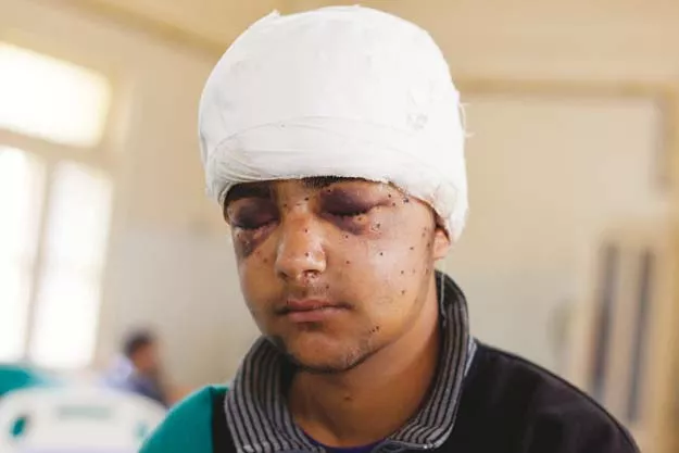 a boy from kashmir injured in pellet gun attack photo file a boy from kashmir injured in pellet gun attack photo file