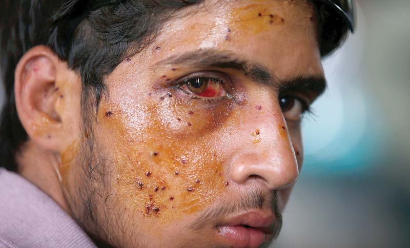 a kashmiri youth with eye injuries inflicted by pellets fired by indian forces photo afp