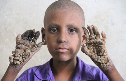 a rare condition is turning this boy s hands and feet into trees a rare condition is turning this boy s hands and feet into trees