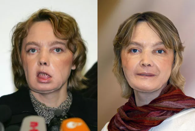 this combination of pictures dated l february 6 2006 and r from november 2006 of french isabelle dinoire 39 a few months after her surgery operation carried out jointly by an amiens and lyon team who underwent the world 039 s first facial face transplant and a year later photo afp this combination of pictures dated l february 6 2006 and r from november 2006 of french isabelle dinoire 39 a few months after her surgery operation carried out jointly by an amiens and lyon team who underwent the world 039 s first facial face transplant and a year later photo afp