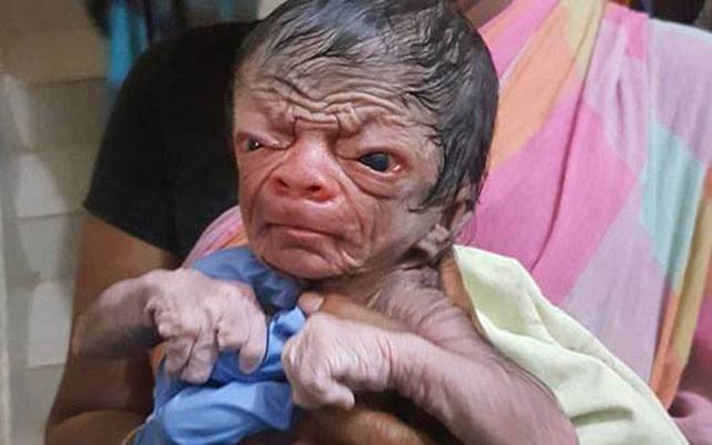 A rare medical condition makes this newborn resemble an 80-year-old
