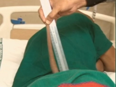 neurosurgeons remove 18 cm long tail from indian boy s back neurosurgeons remove 18 cm long tail from indian boy s back