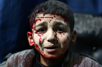 saudi arabia to fund treatment of 150 injured syrian children saudi arabia to fund treatment of 150 injured syrian children