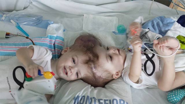 the twins who also underwent skull reconstruction will be intubated while their brains and vital signs are monitored photo facebook