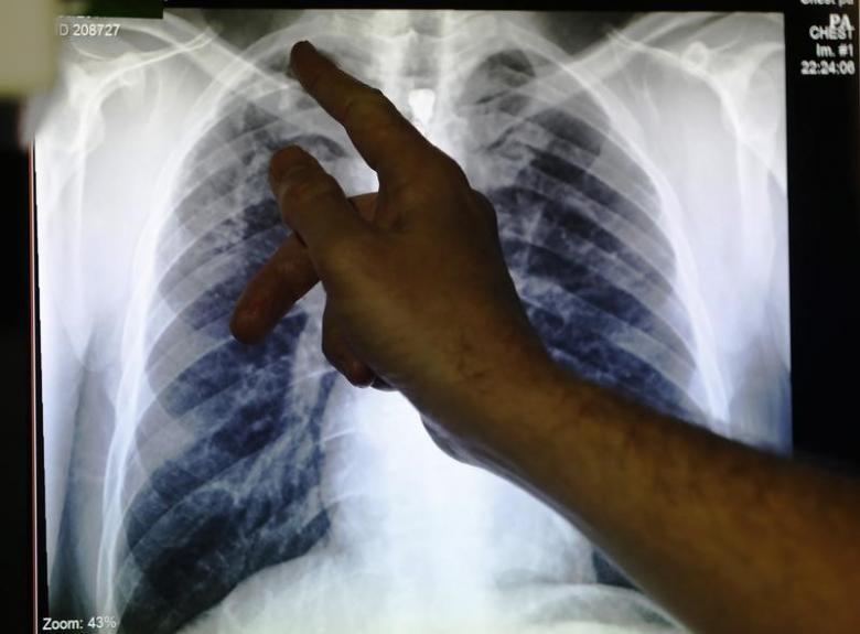 clinical lead doctor al story points to an x ray showing a pair of lungs infected with tb photo reuters