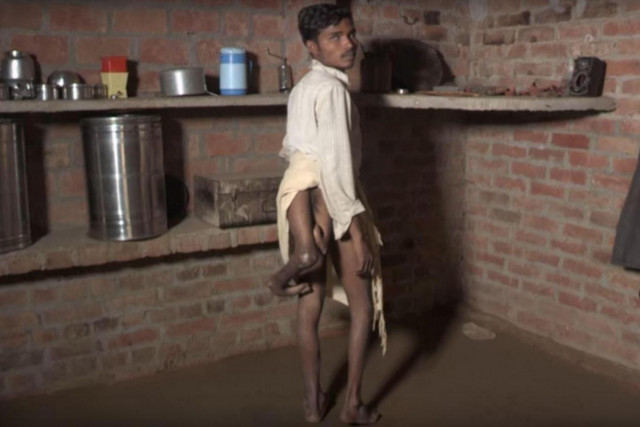 twenty two year old arun kumar was born with a unique deformity four legs photo youtube screen grab twenty two year old arun kumar was born with a unique deformity four legs photo youtube screen grab