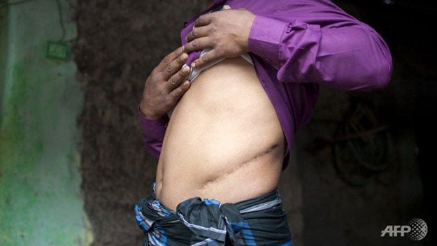 bangladeshi villager belal hossian 35 a victim of illegal organ trade shows the scars from his illegal kidney removal operation photo afp