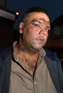 british pakistani man left with horrific burns after acid attack in london british pakistani man left with horrific burns after acid attack in london