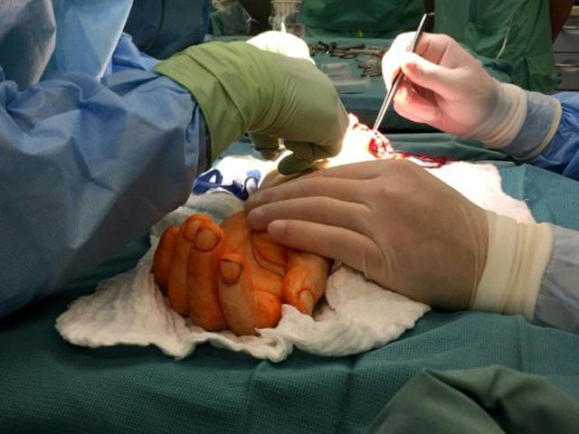 surgeons attach a hand from a deceased donor to a man born without one at at wroclaw medical university hospital photo afp