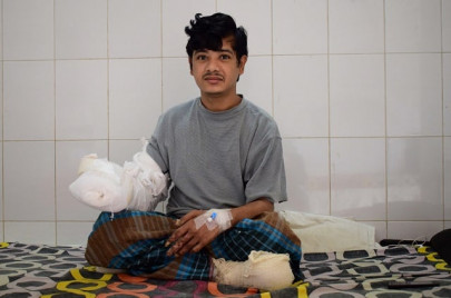 bangladesh tree man sees hope after 16 surgeries bangladesh tree man sees hope after 16 surgeries