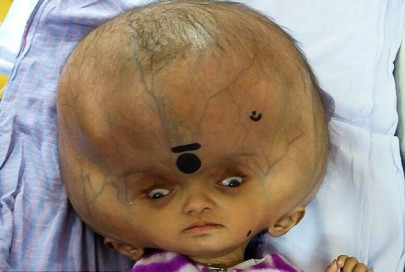 boy with world s largest head undergoes surgery boy with world s largest head undergoes surgery