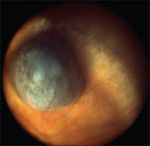 child with retina tumour hopes to be cured during fourth visit child with retina tumour hopes to be cured during fourth visit