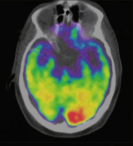 one in four adults may suffer a stroke one in four adults may suffer a stroke