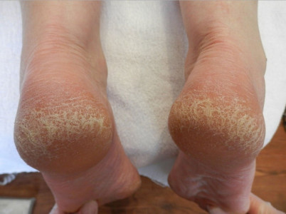 7 desi remedies for cracked heels 7 desi remedies for cracked heels