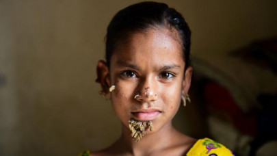 bangladesh treats first case of tree girl syndrome bangladesh treats first case of tree girl syndrome