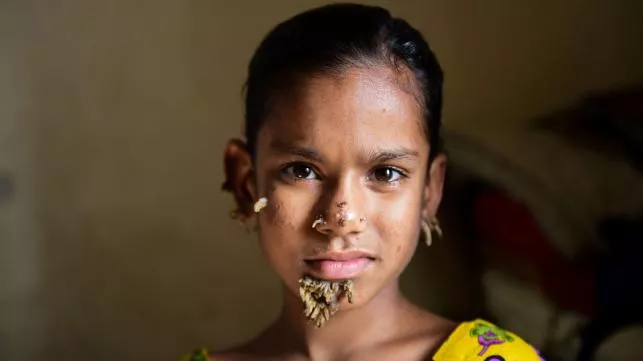 in this photograph taken on 30 january 2017 bangladeshi patient sahana khatun 10 poses for a photograph at the dhaka medical college and hospital photo afp in this photograph taken on 30 january 2017 bangladeshi patient sahana khatun 10 poses for a photograph at the dhaka medical college and hospital photo afp