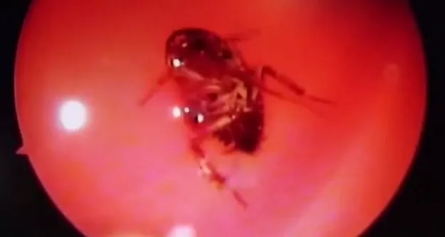 the invasive critter had burrowed deep inside her nose almost to the base of the skull and was still alive after roughly 12 hours screengrab the invasive critter had burrowed deep inside her nose almost to the base of the skull and was still alive after roughly 12 hours screengrab