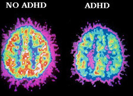 a pet scan ullustrating difference between a brain with adhd and one without photo neurosciencenews