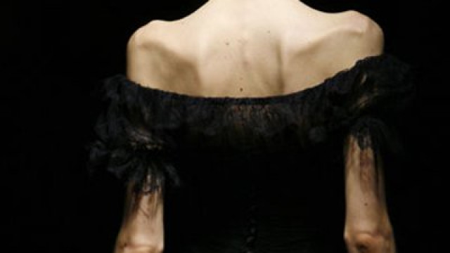 anorexia is a serious eating disorder that affects around 0 5 per cent of people worldwide the majority of them teenage girls photo reuters