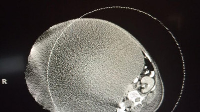 doctors remove woman s 140 pound tumour doctors remove woman s 140 pound tumour