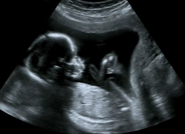 speakers say around 70 of couples not using anything to prevent unwanted pregnancies stock image