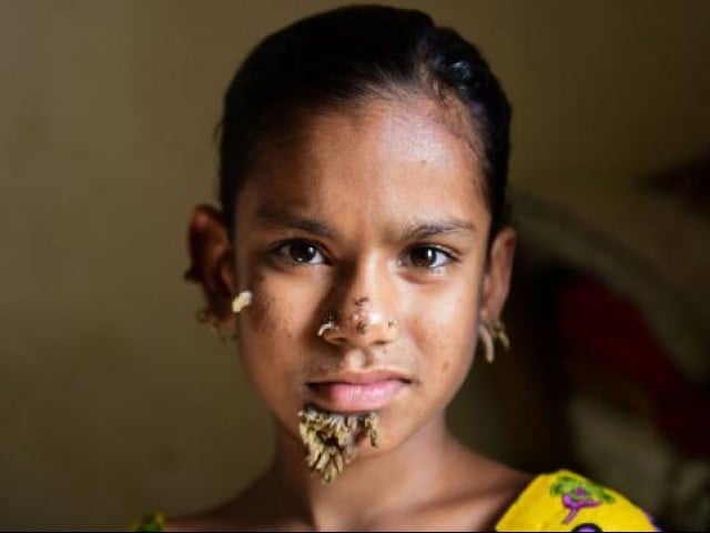 in this photograph taken on 30 january 2017 bangladeshi patient sahana khatun 10 poses for a photograph at the dhaka medical college and hospital photo afp