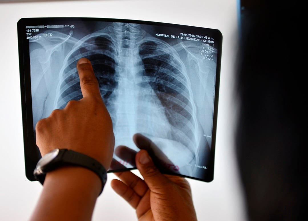TB patients deterred from seeking help - Vimarsana News