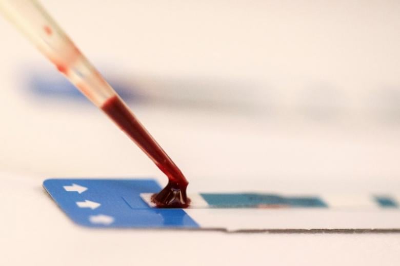 a nurse tests a blood sample during a free hiv test photo reuters