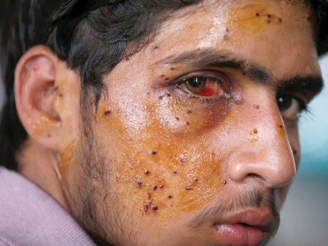 a kashmiri youth with eye injuries inflicted by pellets fired by indian forces photo afp file