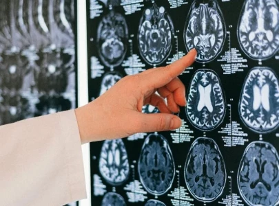 patients struggle to access neurological facilities